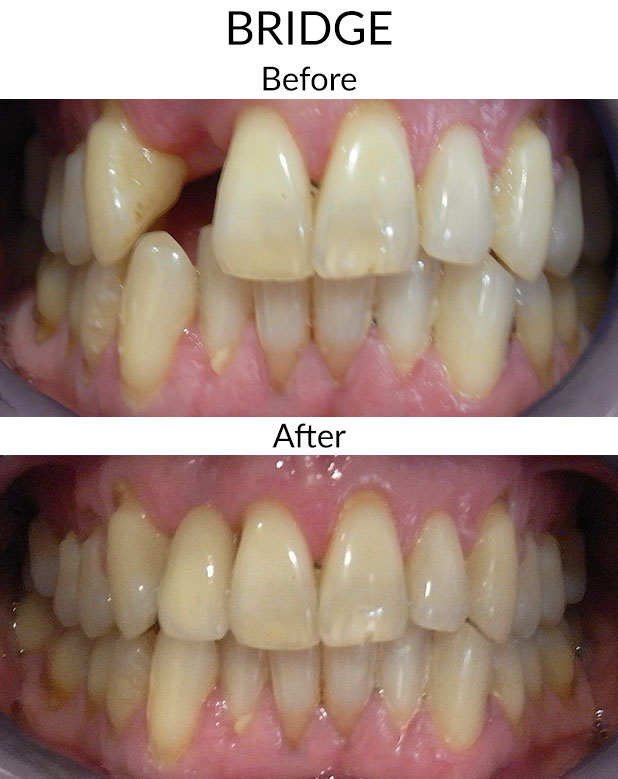 Bridge Before & After