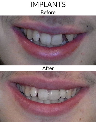 implant