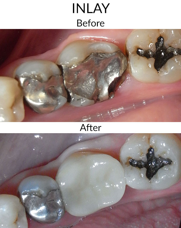 Inlay Before & After