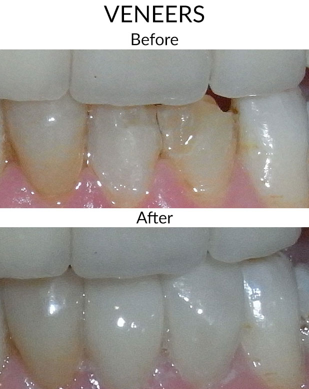 Veneers Before & After